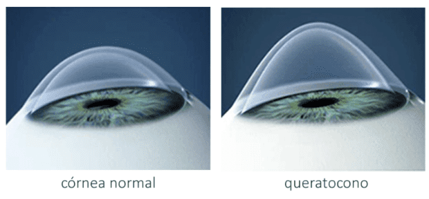 Cornea Normal